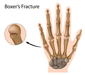 boxers-fracture-the-most-common-finger-fracture